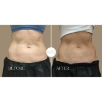 Coolsculpting Coolsculpting Procedure Before & After by Wilmington Plastic Surgery