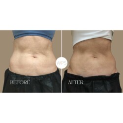 Coolsculpting Coolsculpting Procedure Before & After by Wilmington Plastic Surgery