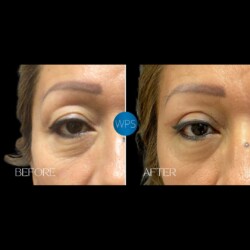 Eyelid Surgery by Dr. Morgan Eyelid Surgery Procedure Before & After by Dr. Morgan at Wilmington Plastic Surgery