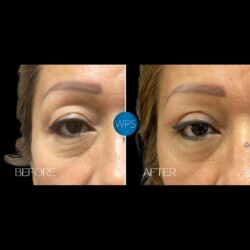 Eyelid Surgery by Dr. Morgan Eyelid Surgery Procedure Before & After by Dr. Morgan at Wilmington Plastic Surgery