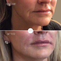 Filler Filler Procedure Before & After by Wilmington Plastic Surgery