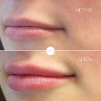 Filler Filler Procedure Before & After by Wilmington Plastic Surgery