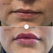 Filler Filler Procedure Before & After by Wilmington Plastic Surgery