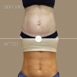 Coolsculpting by Karie Coolsculpting Procedure Before & After by Wilmington Plastic Surgery