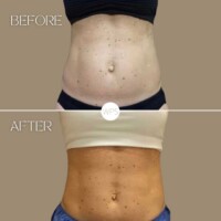 Coolsculpting by Karie Coolsculpting Procedure Before & After by Wilmington Plastic Surgery