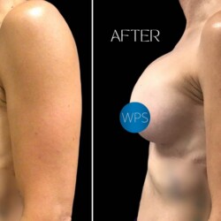 6 weeks post op breast augmentation by Dr. Morgan at Wilmington Plastic Surgery & Med Spa 6 weeks post op breast augmentation by Dr. Morgan at Wilmington Plastic Surgery & Med Spa