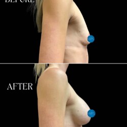 5 months post-op Bilateral augment part 1 performed by Dr. Morgan at Wilmington Plastic Surgery & Med Spa 5 months post-op Bilateral augment part 1 performed by Dr. Morgan at Wilmington Plastic Surgery & Med Spa