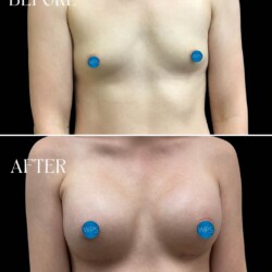 A natural looking implant enhanced this patients overall breast contour by increasing volume and improving both symmetry and proportion. With a custom tailored treatment, our talented plastic surgeons ensure patient satisfaction! A natural looking implant enhanced this patients overall breast contour by increasing volume and improving both symmetry and proportion. With a custom tailored treatment, our talented plastic surgeons ensure patient satisfaction!