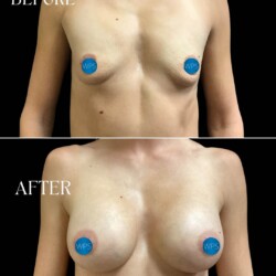 5 months post-op Bilateral augment part 2 performed by Dr. Morgan at Wilmington Plastic Surgery & Med Spa 5 months post-op Bilateral augment part 2 performed by Dr. Morgan at Wilmington Plastic Surgery & Med Spa