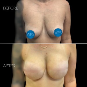 Breast Reconstruction - Dr. Morgan Breast Reconstruction by Dr. Morgan