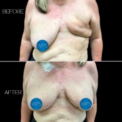 Breast Reconstruction - Dr. Morgan Breast Reconstruction by Dr. Morgan