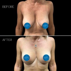 Breast Lift Breast Lift by Dr. Morgan at Wilmington Plastic Surgery
