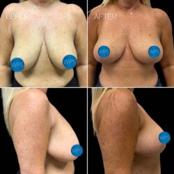 Breast Lift by Dr. Morgan Breast Lift by Dr. Morgan at Wilmington Plastic Surgery