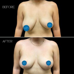 Breast Lift & Reduction - Dr. Morgan Breast Lift & Reduction by Dr. Morgan at Wilmington Plastic Surgery
