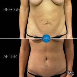 Tummy Tuck Tummy Tuck by Dr. Morgan at Wilmington Plastic Surgery Before & After Results