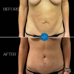 Tummy Tuck Tummy Tuck by Dr. Morgan at Wilmington Plastic Surgery Before & After Results