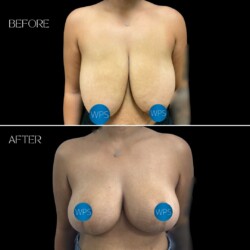 Breast Reduction - Dr. Morgan Breast Reduction Surgery Before & After by Dr. Morgan at Wilmington Plastic Surgery