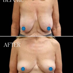 Breast Reduction - Dr. Glener Breast Reduction Surgery Before & After by Dr. Glener at Wilmington Plastic Surgery
