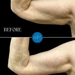 Brachioplasty - Dr. Morgan Brachioplasty Surgery Before & After by Dr. Morgan at Wilmington Plastic Surgery