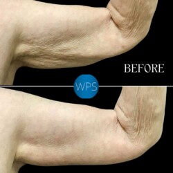 Brachioplasty - Dr. Morgan Brachioplasty Surgery Before & After by Dr. Morgan at Wilmington Plastic Surgery