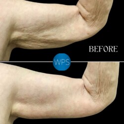 Brachioplasty - Dr. Morgan Brachioplasty Surgery Before & After by Dr. Morgan at Wilmington Plastic Surgery