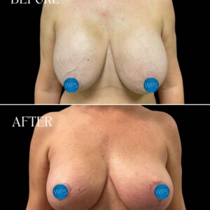 Breast Reconstruction - Dr. Morgan Breast Reconstruction Surgery by Dr. Morgan at Wilmington Plastic Surgery & Med Spa