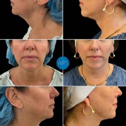 Lower Facelift - Dr. Morgan Lower Facelift Surgery performed by Dr. Morgan at Wilmington Plastic Surgery & Med Spa