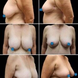 Breast Lift by Dr. Glener Breast Lift Surgery Before & After by Dr. Glener at Wilmington Plastic Surgery