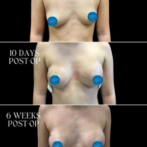 Breast Reconstruction - Dr. Morgan Breast Reconstruction Surgery by Dr. Morgan at Wilmington Plastic Surgery & Med Spa