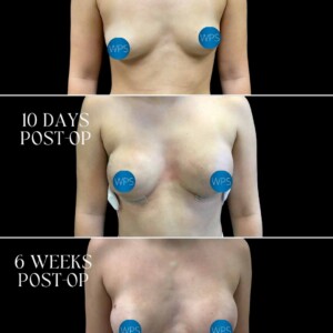 Breast Reconstruction - Dr. Morgan Breast Reconstruction Surgery by Dr. Morgan at Wilmington Plastic Surgery & Med Spa