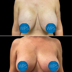 Breast Reconstruction - Dr. Morgan Breast Reconstruction Surgery by Dr. Morgan at Wilmington Plastic Surgery & Med Spa