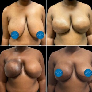 Breast Reconstruction - Dr. Morgan Breast Reconstruction Surgery by Dr. Morgan at Wilmington Plastic Surgery & Med Spa