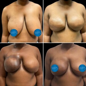 Breast Reconstruction - Dr. Morgan Breast Reconstruction Surgery by Dr. Morgan at Wilmington Plastic Surgery & Med Spa