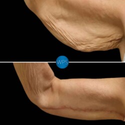 Patient was bothered by the excess skin in her upper arms after weight loss. Dr. Glener addressed her concerns with a Brachioplasty, resulting in an enhanced but natural contour - intentionally places the scar on the inside of the arm, so it is concealed unless intentionally revealed. Brachioplasty Surgery Before & After by Dr. Glener at Wilmington Plastic Surgery