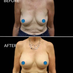 Breast Augmentation - Dr. Glener Breast Augmentation Surgery Before & After by Dr. Glener at Wilmington Plastic Surgery & Med Spa