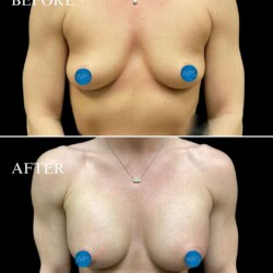 Breast Augmentation - Dr. Glener Breast Augmentation Surgery Before & After by Dr. Glener at Wilmington Plastic Surgery & Med Spa