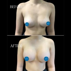 Breast Augmentation by Dr. Morgan Breast Augmentation Surgery Before & After by Dr. Morgan at Wilmington Plastic Surgery