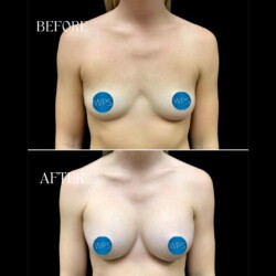 Breast Augmentation by Dr. Morgan Breast Augmentation Surgery Before & After by Dr. Morgan at Wilmington Plastic Surgery