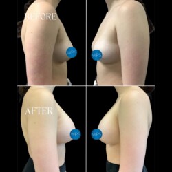 Breast Augmentation by Dr. Morgan Breast Augmentation Surgery Before & After by Dr. Morgan at Wilmington Plastic Surgery