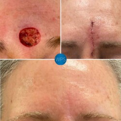 This patient had Melanoma In Situ (cancerous) Dr. Morgan needed 5 mm margins to remove the melanoma which required a skin graft closure. Scars take a full 12-18mths to fully mature - patient was instructed to avoid UV exposure and wear proper facial sunscreen. This patient had Melanoma In Situ (cancerous) Dr. Morgan needed 5 mm margins to remove the melanoma which required a skin graft closure. Scars take a full 12-18mths to fully mature - patient was instructed to avoid UV exposure and wear proper facial sunscreen.