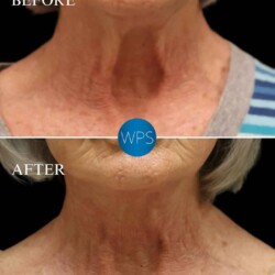 Neck Lift - Dr. Glener Neck Lift Surgery performed by Dr. Glener at Wilmington Plastic Surgery & Med Spa