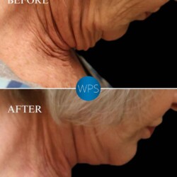Neck Lift - Dr. Glener Neck Lift Surgery performed by Dr. Glener at Wilmington Plastic Surgery & Med Spa