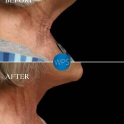 Neck Lift - Dr. Glener Neck Lift Surgery performed by Dr. Glener at Wilmington Plastic Surgery & Med Spa