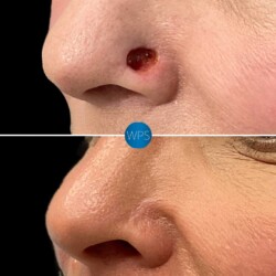 8 months post op skin cancer removal by Dr. Morgan at Wilmington Plastic Surgery & Med Spa. 8 months post op skin cancer removal by Dr. Morgan at Wilmington Plastic Surgery & Med Spa.