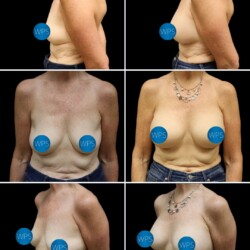 This patient is pictured 1-month following a Rapid Recovery Breast Augmentation by Dr. Glener - She is back enjoying her active lifestyle and exercising with caution as she continues to heal. This patient is pictured 1-month following a Rapid Recovery Breast Augmentation by Dr. Glener - She is back enjoying her active lifestyle and exercising with caution as she continues to heal.