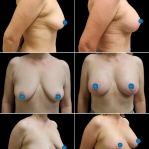 Patient underwent a combined implant placement and lift to achieve upper pole fullness. Patient underwent a combined implant placement and lift to achieve upper pole fullness.