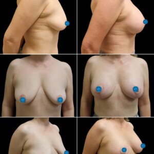 Patient underwent a combined implant placement and lift to achieve upper pole fullness. Patient underwent a combined implant placement and lift to achieve upper pole fullness.