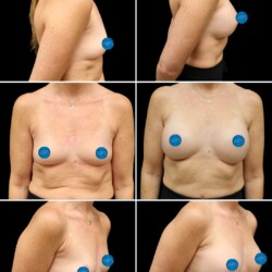 Breast augmentation by Dr. Glener 4 weeks post op Breast augmentation by Dr. Glener at Wilmington Plastic Surgery & Med Spa 4 weeks post op