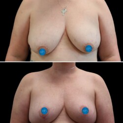 Breast reconstruction - left / breast reduction - right pictured 3 months post op by Dr. Glener Breast reconstruction - left / breast reduction - right pictured 3 months post op by Dr. Glener at Wilmington Plastic Surgery & Med Spa