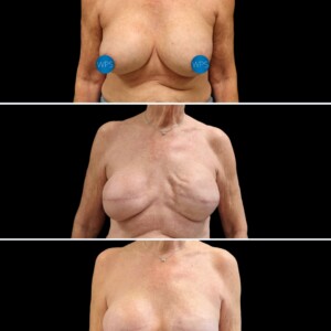 Breast reconstruction by Dr. Glener Breast reconstruction by Dr. Glener at Wilmington Plastic Surgery & Med Spa